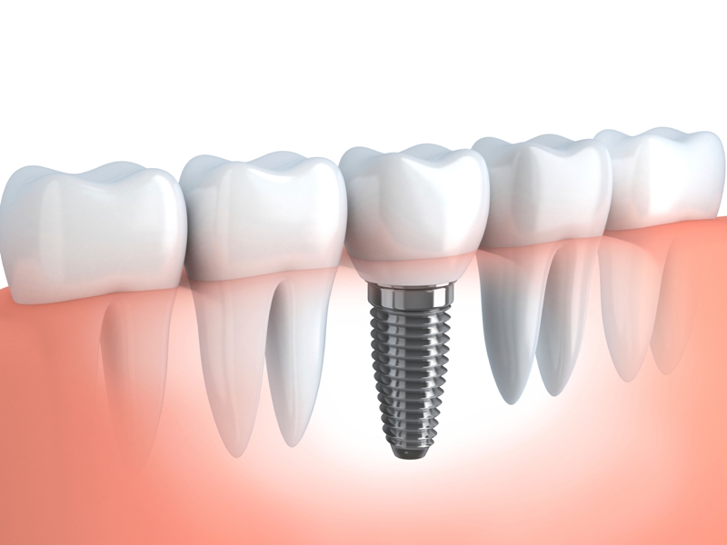 Tooth Removal